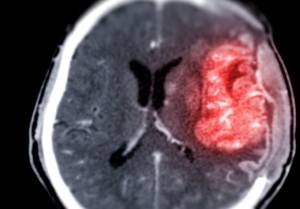 Pancreatic Cancer: Associated Signs, Symptoms, Risk Factors and Treatment Approaches