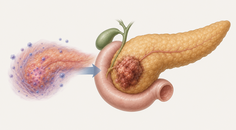 pancreatic ductal adenocarcinoma with autoimmune pancreatitis