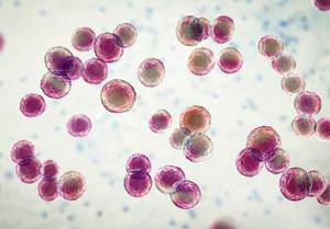 Life After Ovarian Cancer: Protecting Sexual and General Health for Survivors